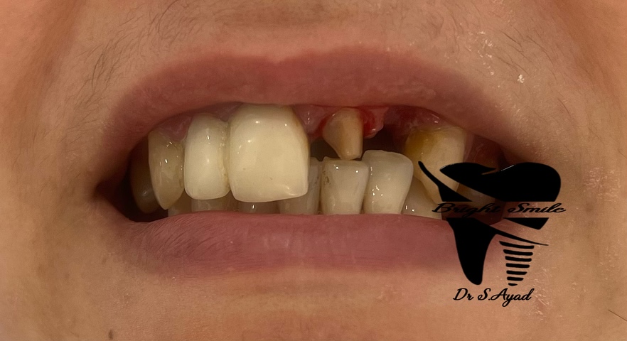 Bright Smile Dental Clinic - Transformation dentaire